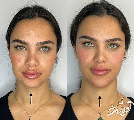 زاویه سازی صورت با ژل بهتره یا چربی, زاویه سازی صورت با ژل, تزریق ژل زاویه فک